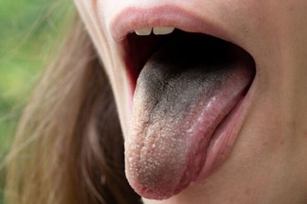 5 Hal yang Perlu Dihindari Agar Lidah Tidak Iritasi 5 Hal yang Perlu Dihindari Agar Lidah Tidak Iritasi