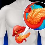 5 Tips Menjalani Hidup Sehat Setelah Diagnosis Pankreatitis