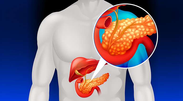 5 Tips Menjalani Hidup Sehat Setelah Diagnosis Pankreatitis