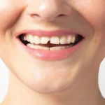 7 Cara Mencegah Gigi Retak dan Patah