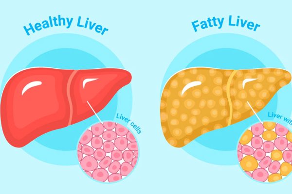 7 Kebiasaan Sehat untuk Penderita Fatty Liver 7 Kebiasaan Sehat untuk Penderita Fatty Liver