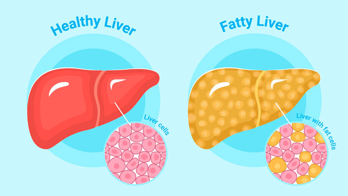 7 Kebiasaan Sehat untuk Penderita Fatty Liver