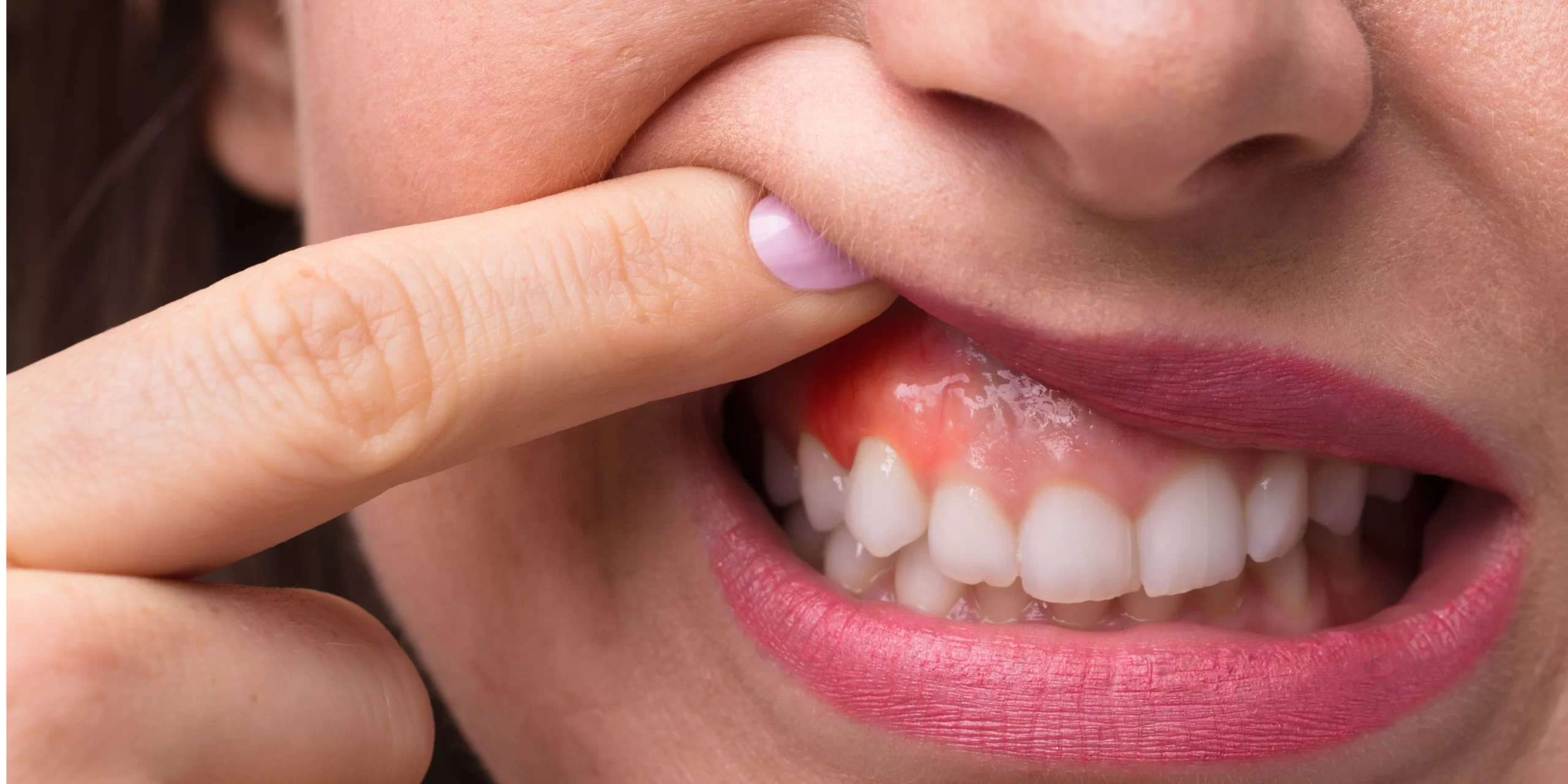10 Langkah Mudah Mengatasi Gusi Bengkak Tanpa Obat