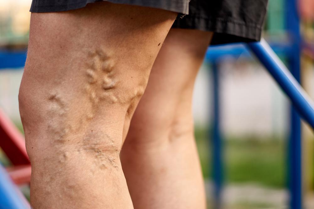10 Cara Menghindari Varises di Sekitar Paha