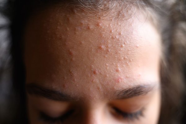 5 Langkah Sederhana Mencegah Jerawat di Dahi dan Pipi