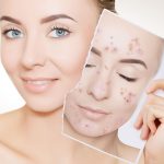 10 Tips Mengatasi Jerawat Tanpa Obat Kimia
